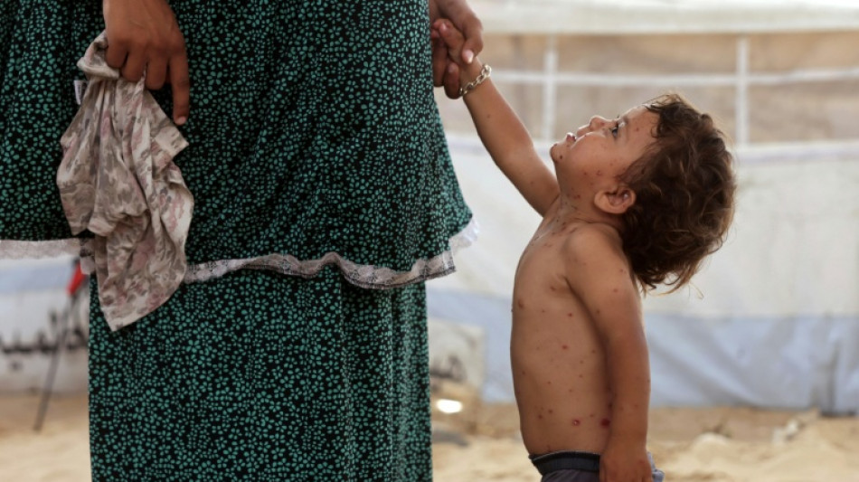 La varicela se propaga en los saturados campamentos de Gaza