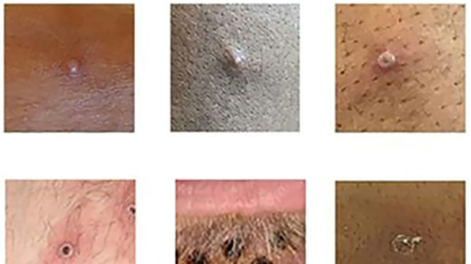 Variole du singe: sympt&ocirc;mes, diagnostic, traitements, vaccins