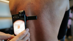 En Occitanie, des kin&eacute;s "lanceurs d'alerte" form&eacute;s &agrave; rep&eacute;rer les m&eacute;lanomes