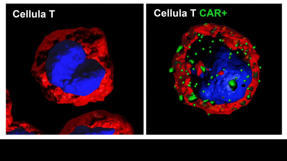 Linfomi, il 70-75% dei pazienti può guarire o vivere a lungo